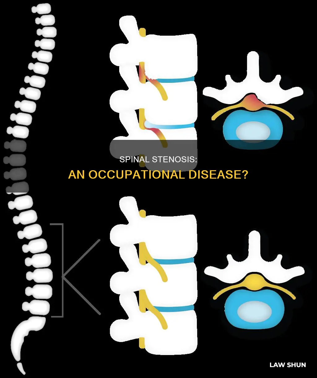 can spinal stenosis by any occupational disease law